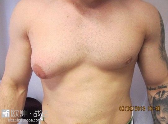 英国男子长B杯乳房欲做手术被拒 自己动手割掉