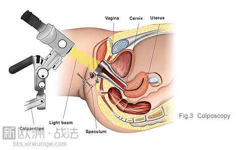 cervical_fig03_colposcopy.jpg