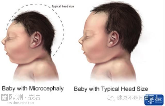 Zika:中国首例病情好转，哥伦比亚5000多名孕妇感染，疫苗问世至少还要18个月 ... ...  ...