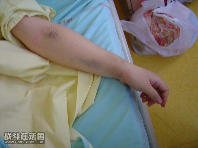 一片一片的针眼，30多个～