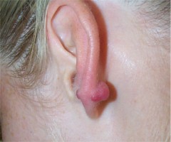cheloide-oreille-1.jpg