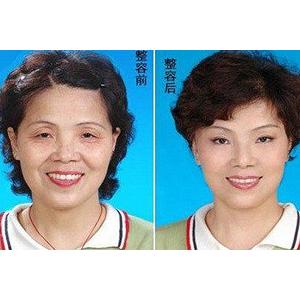59岁大妈五年整容19次 老公称不见她终生遗憾