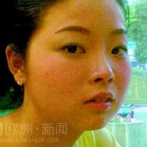 22岁美女得怪病脸肿似月盘 全球仅300病例